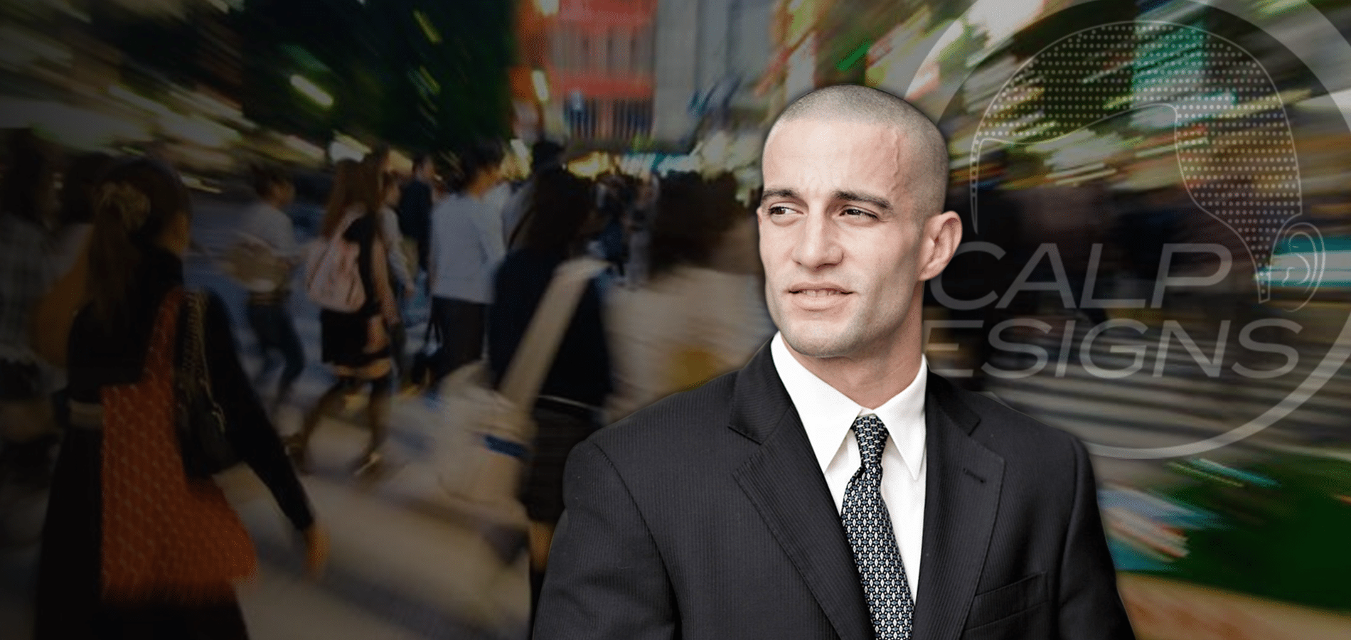 The Norwood Scale – 7 Stages of Hair Loss