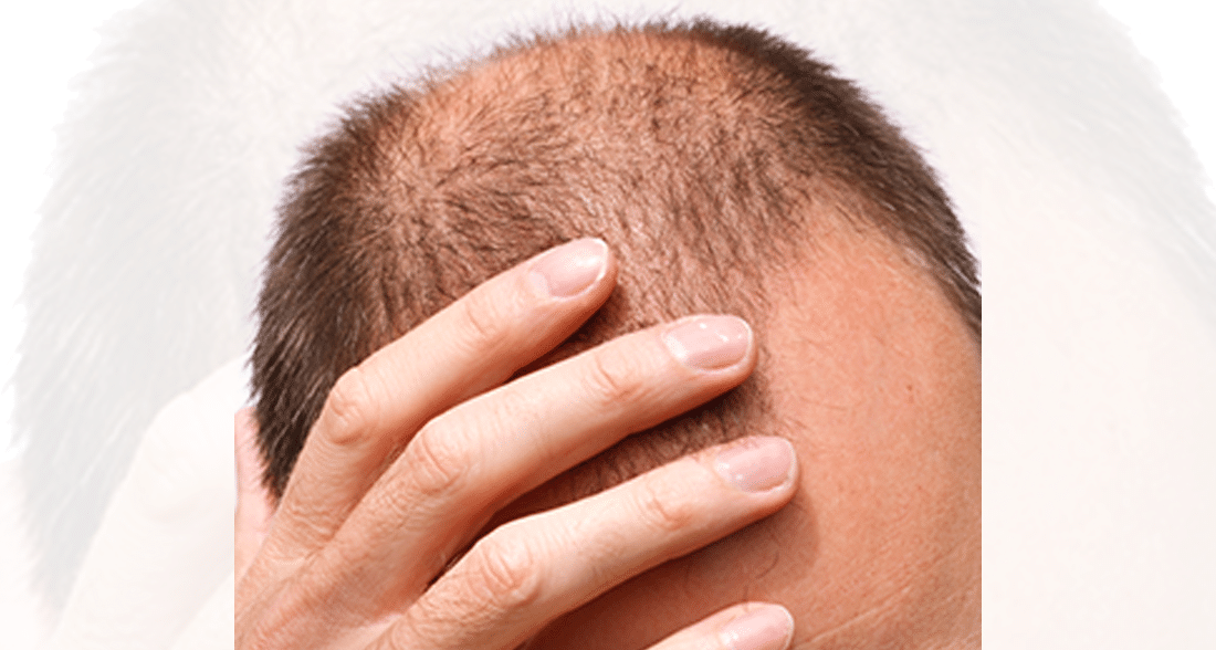 Discoloration is a common concern, and a primary reason why some people decide against scalp micro pigmentation