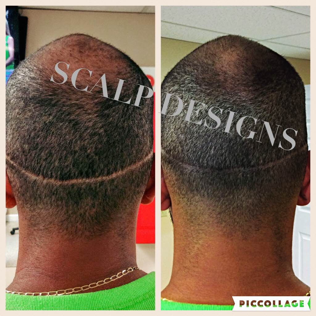 Scalp Micropigmentation vs. Hair Transplant