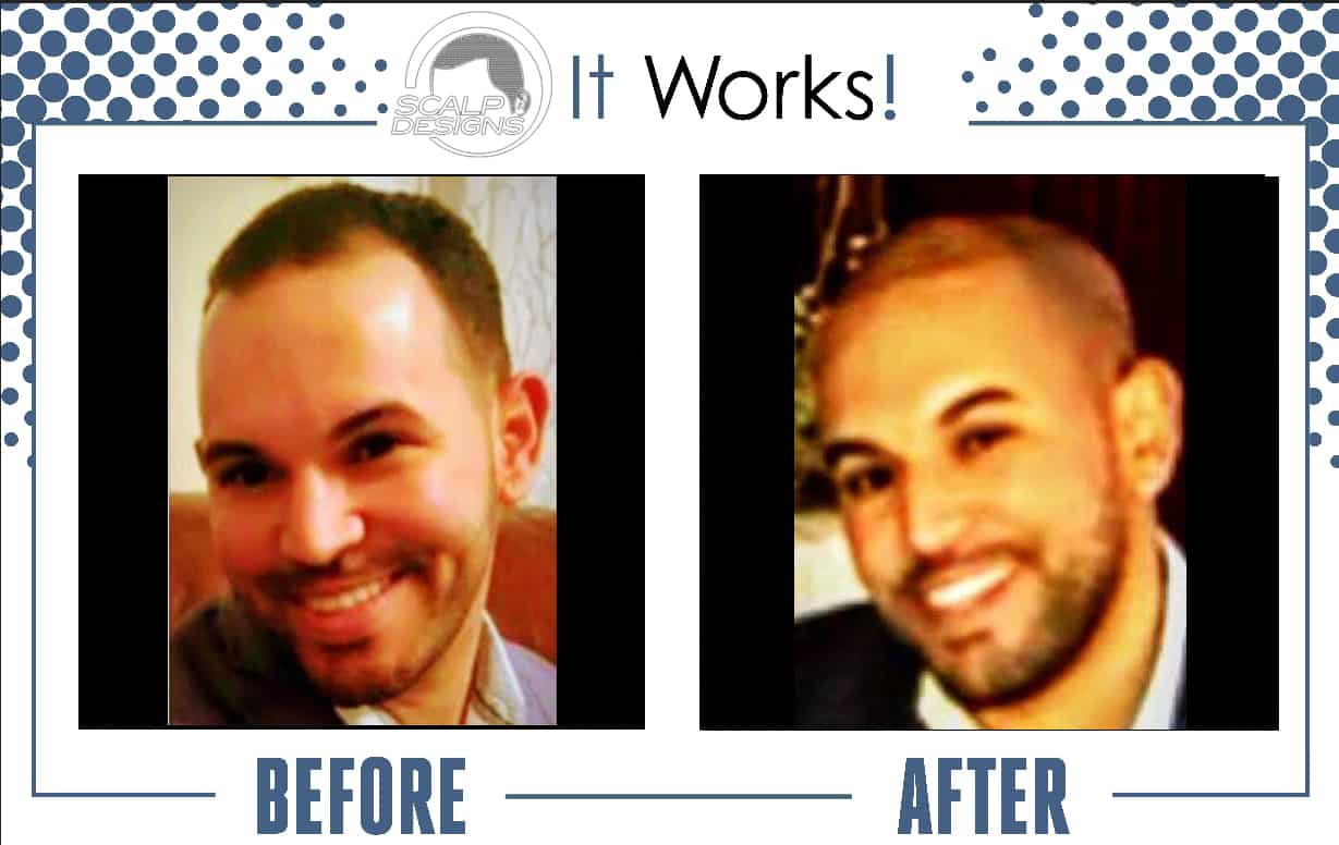 Discover Efficient Hair Loss Treatment