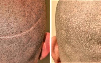 How to Cover Hair Transplant Scars with SMP