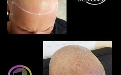 What You Need To Know About Scalp Micro Pigmentation