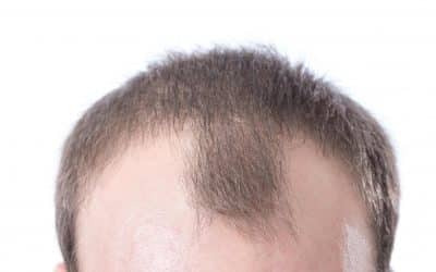 Got a Receding or Uneven Hairline? Here’s What You Can Do