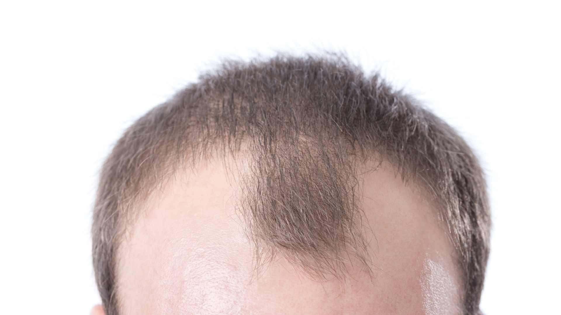 Got a Receding or Uneven Hairline? Here’s What You Can Do Scalp