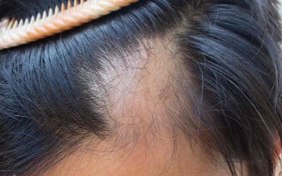 Does Covid-19 Cause Hair Loss?