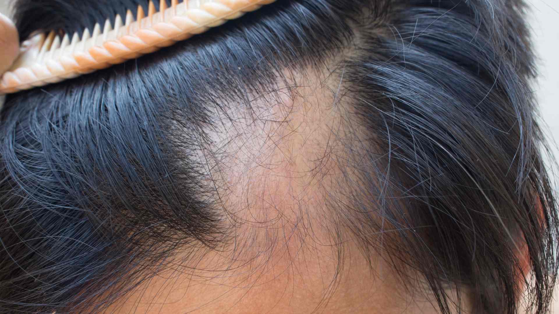 hair loss4 (1)
