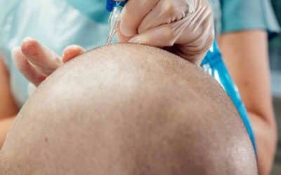 The Benefits of Scalp Micropigmentation