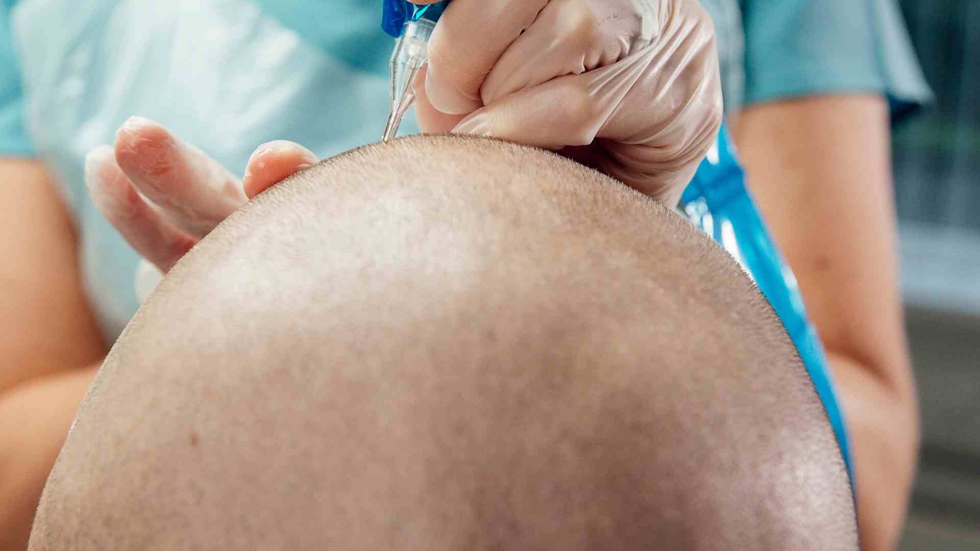 scalp micropigmentation4