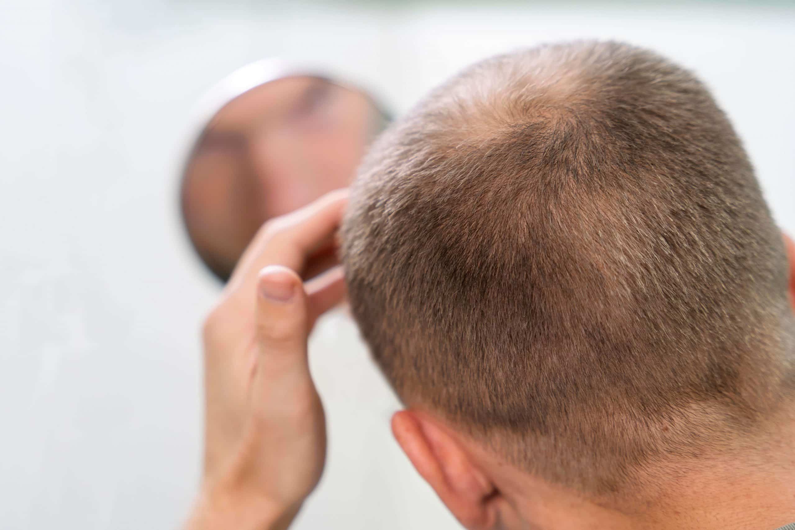 balding man