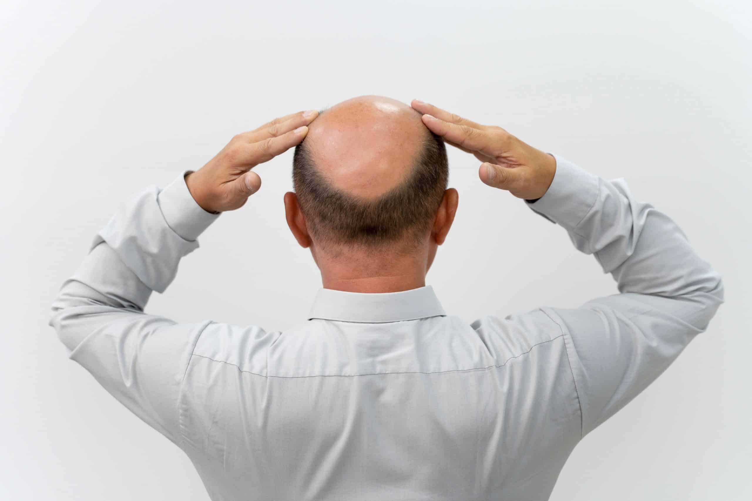 male pattern baldness