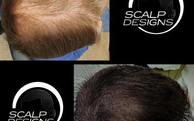 Boston’s Scalp Design: Pioneering the Game in Scalp Micropigmentation