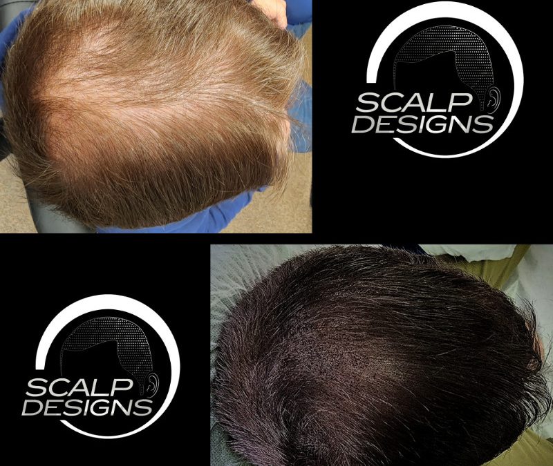 Boston’s Scalp Design: Pioneering the Game in Scalp Micropigmentation