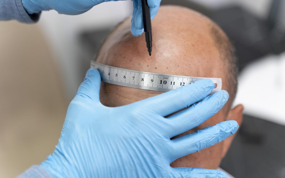 Beyond Hair Loss: Scalp Micropigmentation Redefines Boston’s Approach to Hair Restoration