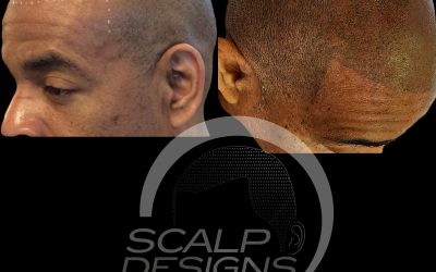 Embracing Every Strand: Stylish Solutions for Hair Thinning in Boston’s Sophisticated Scene