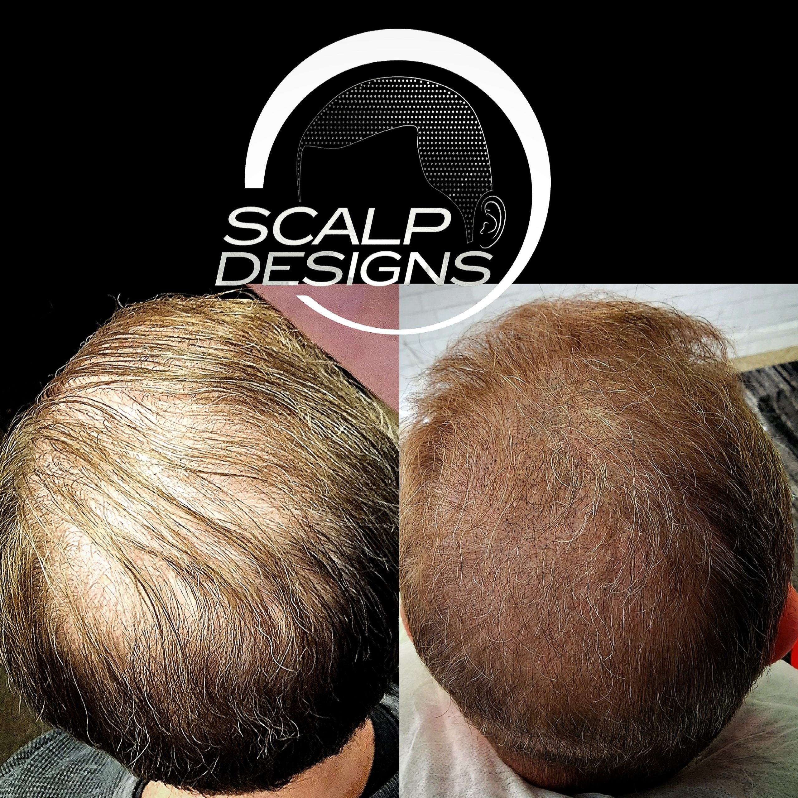 Scalp Micropigmentation