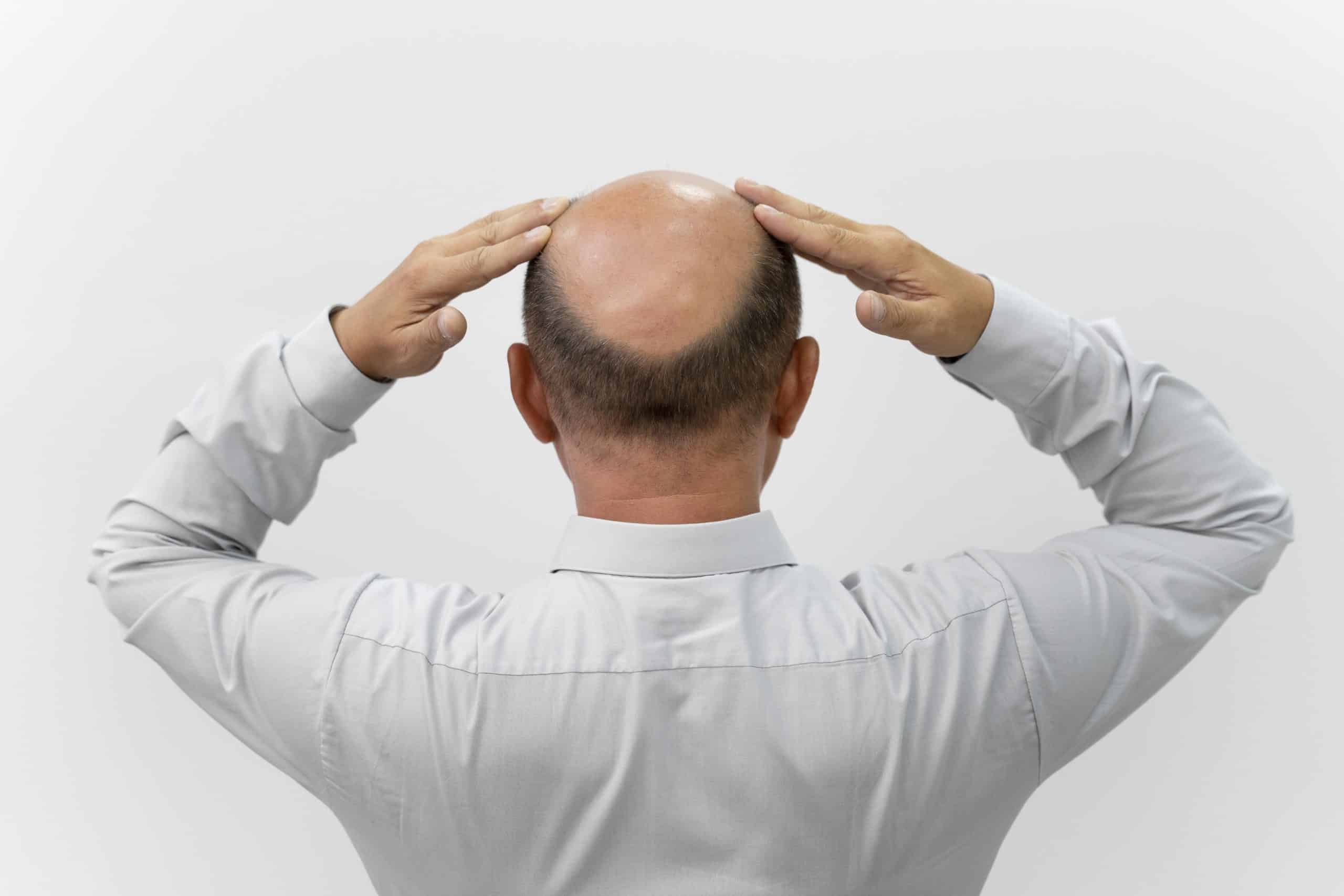 smp for curing baldness boston Smp Curing Baldness