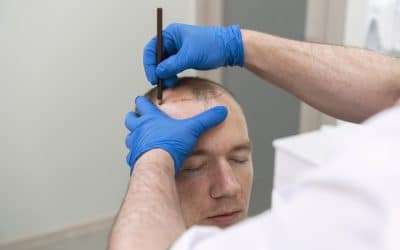 Reclaim Your Confidence: Exploring Hair Replacement Solutions