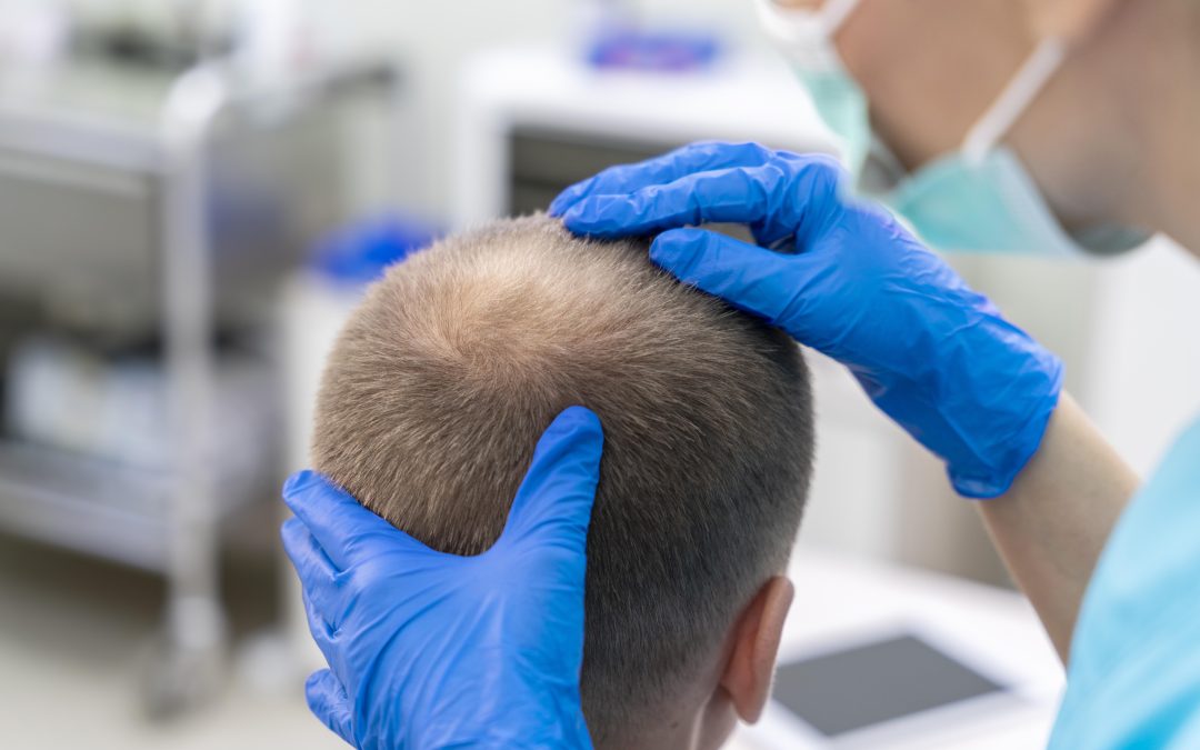 Embracing Destiny: Transform Your Hair with Scalp Micropigmentation