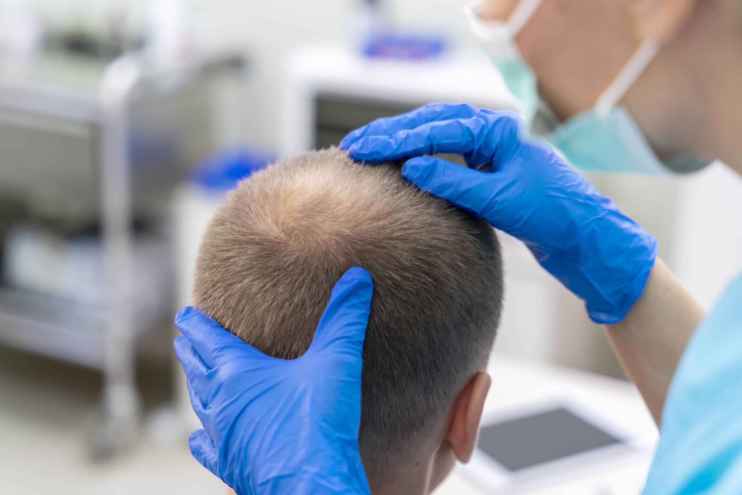 Scalp Micropigmentation in Boston Scalp Micropigmentation in Boston