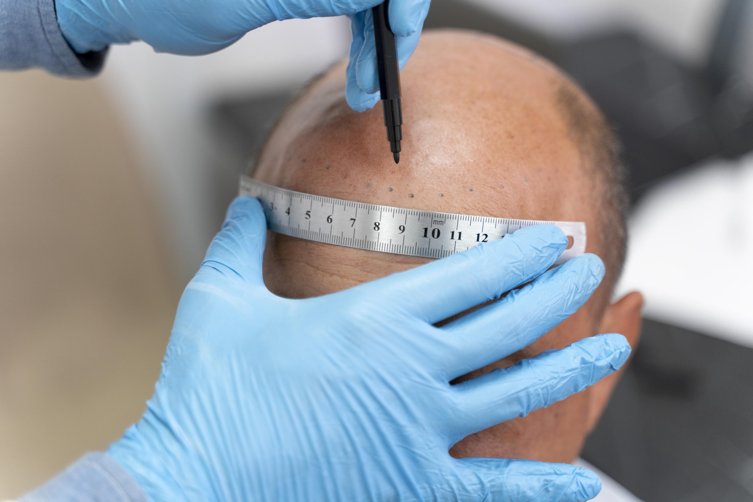 Scalp Micropigmentation in Boston