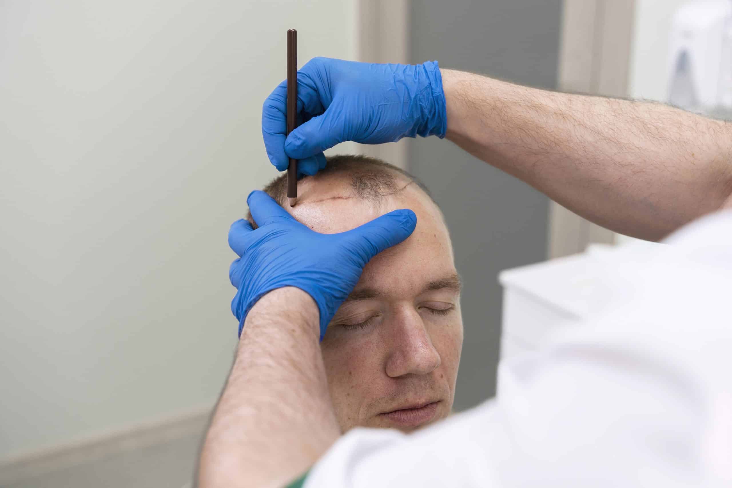 Scalp Micropigmentation, Boston