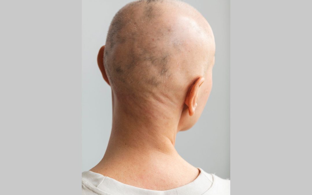 Regaining Confidence: Scalp Micropigmentation in Boston as a Solution for Alopecia