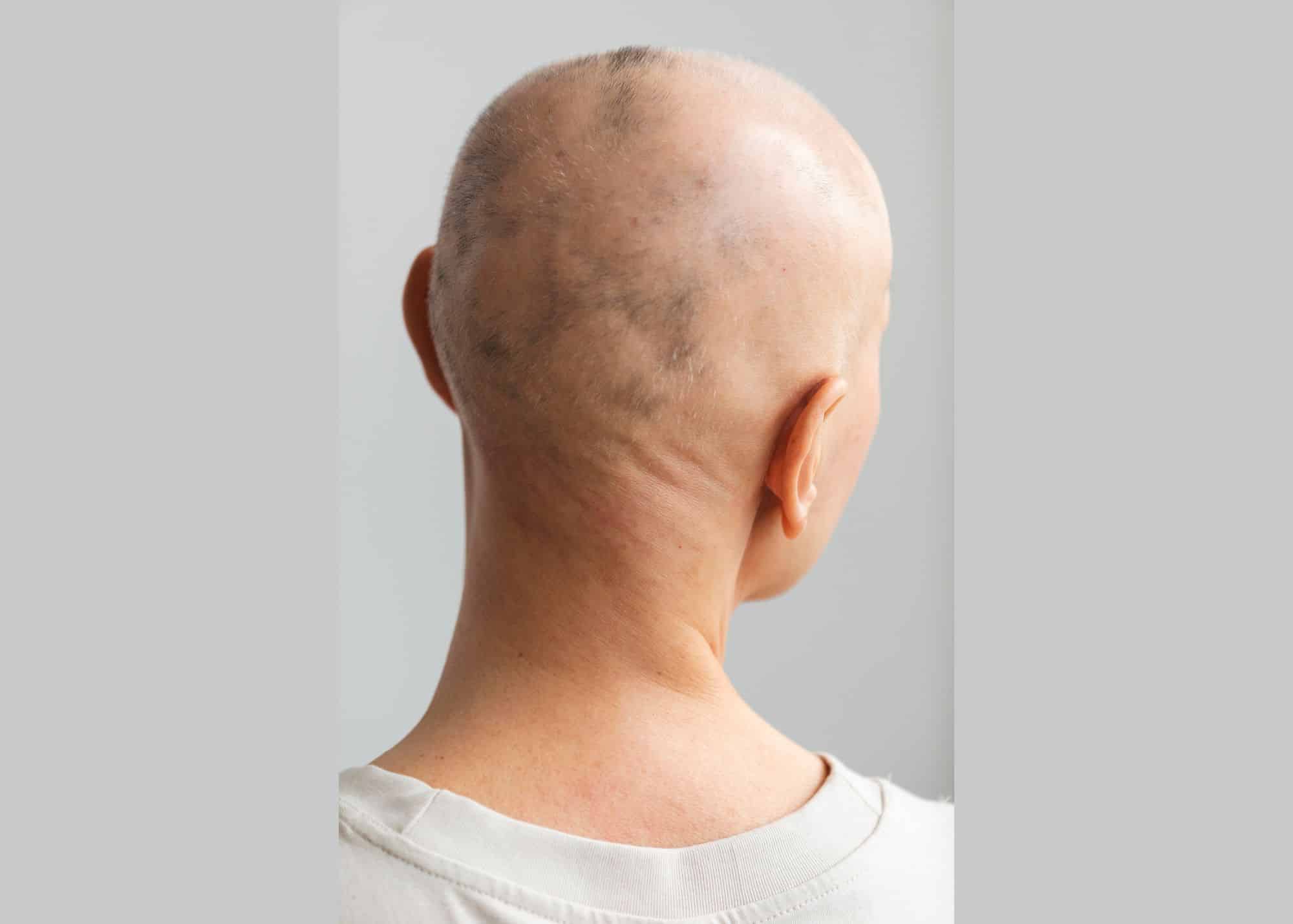 scalp design scalp micropigmentation in Boston, addressing alopecia