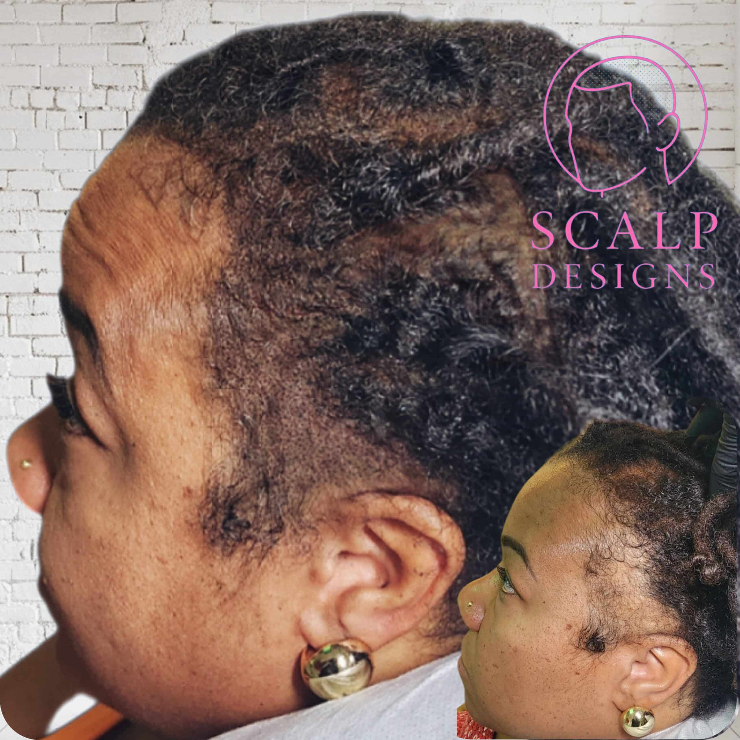 smp results black women Before and after image of a Black woman’s restored hairline using natural-looking scalp micropigmentation at Scalp Designs"