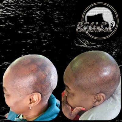 “Before and after alopecia SMP transformation”