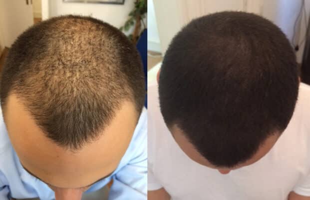 Before and after hair transplant enhanced with Scalp Micropigmentation by Scalp Designs in Boston, showing increased density and scar coverage