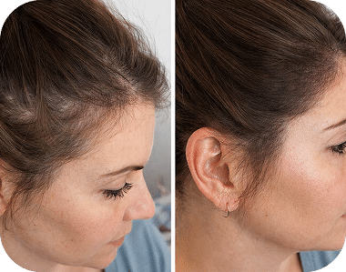 Scalp Micropigmentation for Women in Boston Scalp micropigmentation for women with thinning hair in Boston at Scalp Designs