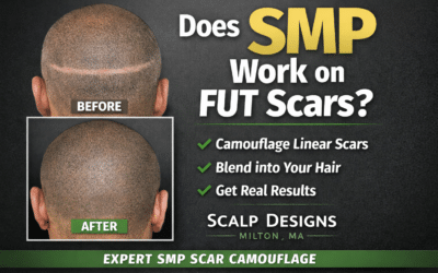 Does SMP Work on FUT Scars? | Scalp Designs Boston