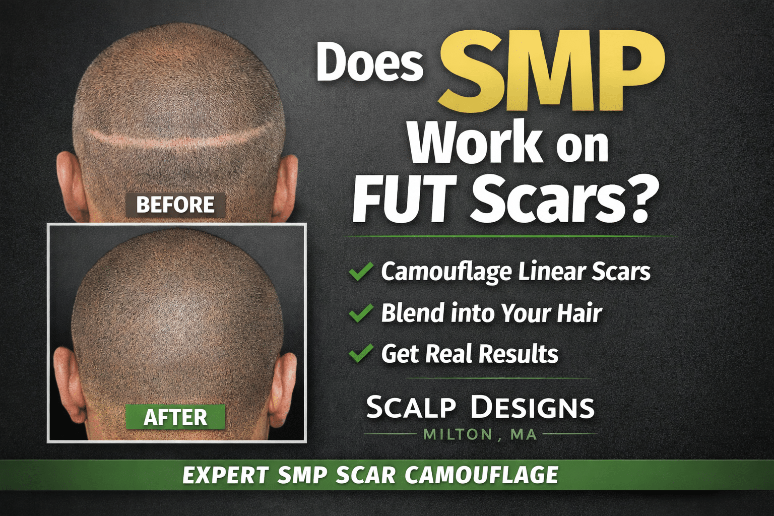 Scalp Designs cover hair transplant scars (3) Before and after scalp micropigmentation hiding a FUT linear hair transplant scar by Scalp Designs near Boston MA