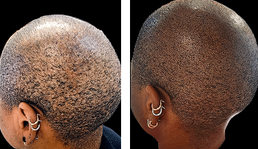 Complete Density Restoration SMP African American Women Scalp Designs African American woman before and after scalp micropigmentation showing complete density restoration across the scalp.
