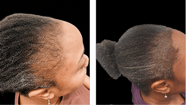 Crown edges restoration smp african american women scalp designs African American woman before and after scalp micropigmentation for crown thinning and edge restoration caused by traction alopecia.