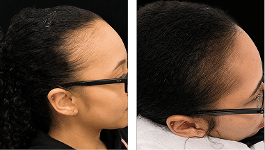 Edges Restoration SMP African American Women Scalp Designs African American woman before and after scalp micropigmentation showing restored thinning edges and improved hairline density.