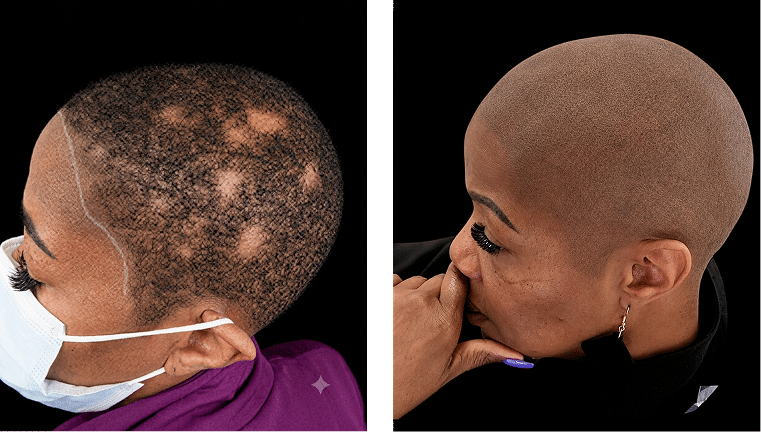 Signature Hairline Restoration Before and After Scalp Micropigmentation Before and after scalp micropigmentation showing signature hairline restoration for an African American woman with advanced hair loss.