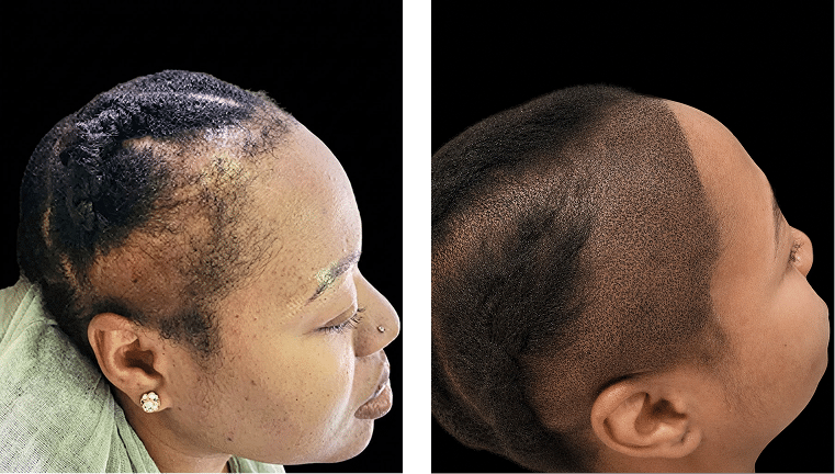 Hairline Reconstruction Before and After Scalp Micropigmentation Before and after scalp micropigmentation results restoring a thinning hairline for an African American woman.