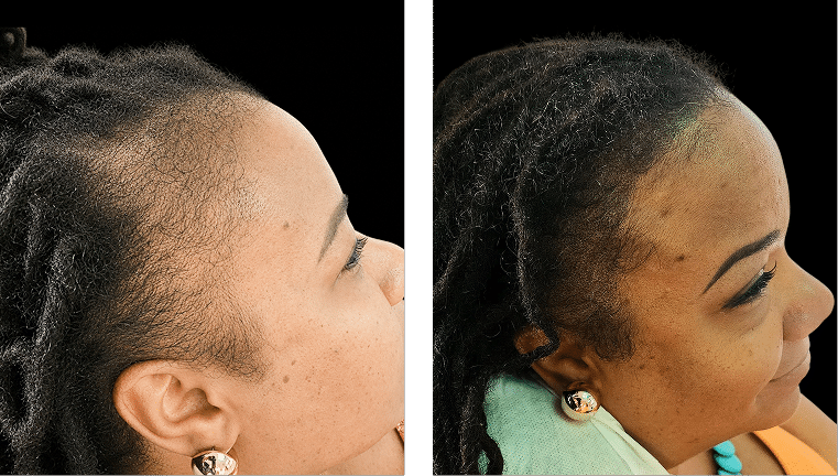 Temple Restoration Before and After Scalp Micropigmentation Before and after scalp micropigmentation improving temple density and hairline definition for an African American woman.