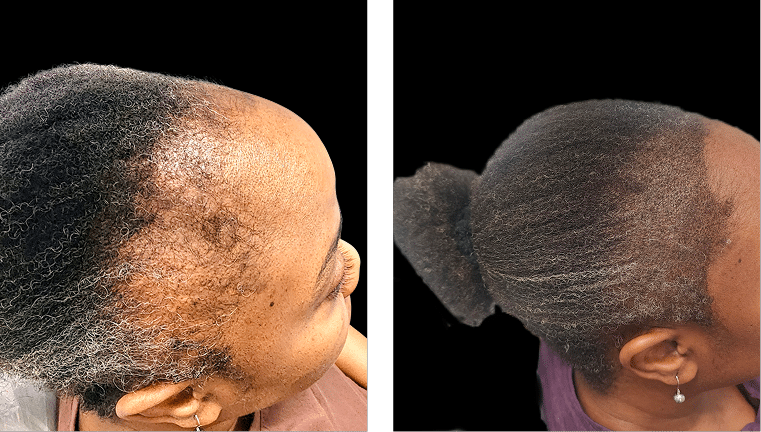 Crown Density Restoration Before and After Scalp Micropigmentation Before and after scalp micropigmentation restoring crown density for an African American woman experiencing thinning hair.