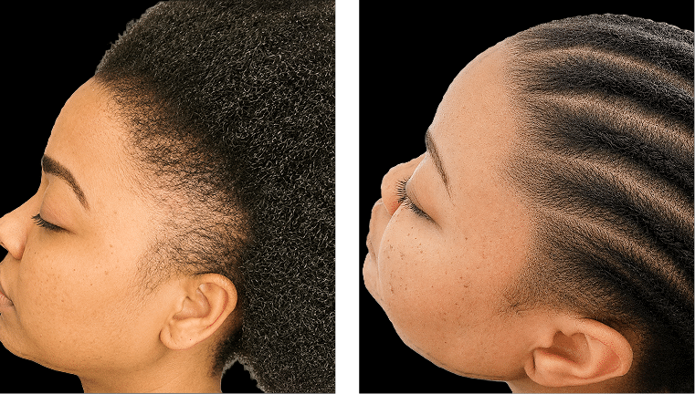 Traction Alopecia Before and After Scalp Micropigmentation Before and after scalp micropigmentation for traction alopecia showing restored scalp coverage and density.