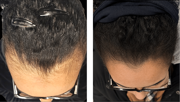 Full Scalp Density Before and After Scalp Micropigmentation Before and after scalp micropigmentation showing full scalp density restoration for an African American woman.