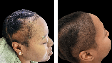 Hairline Reconstruction SMP African American Women Scalp Designs African American woman before and after hairline reconstruction with scalp micropigmentation to restore thinning edges and a natural hairline.
