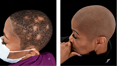 Signature Hairline Restoration SMP African American Women Scalp Designs African American woman before and after signature hairline restoration using scalp micropigmentation for a natural shaved-head appearance.