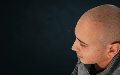 How Long Does Scalp Micropigmentation Last?
