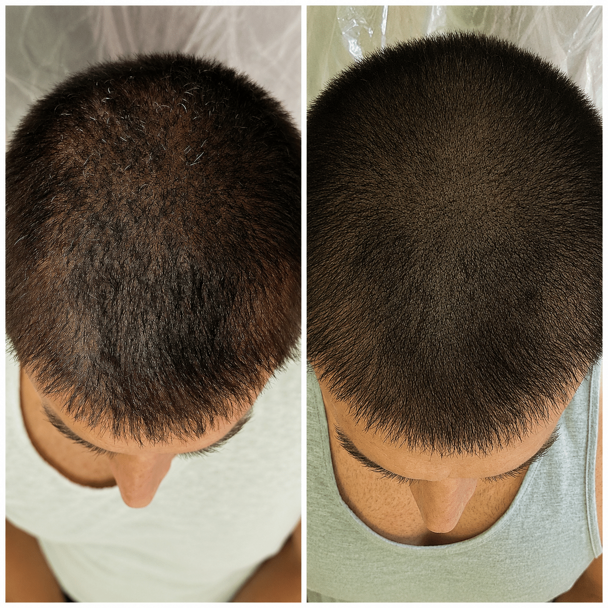 weeks-1-2-fully-healed-scalp-micropigmentation-boston.webp Fully healed scalp micropigmentation results 1 to 2 weeks after treatment showing natural pigment, no redness, and a realistic, shaved head appearance.