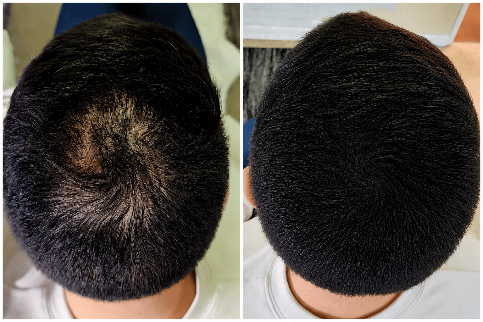 days-1-3-scalp-micropigmentation-healing-boston.webp Scalp micropigmentation healing during days 1 to 3 showing fading redness, tiny micro-scabs forming, and pigment impressions beginning to settle into the skin.